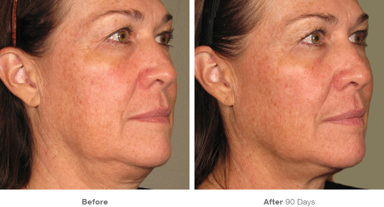 before_after_ultherapy_results_full-face20