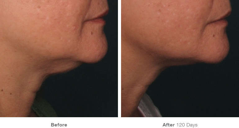 before_after_ultherapy_results_under-chin11