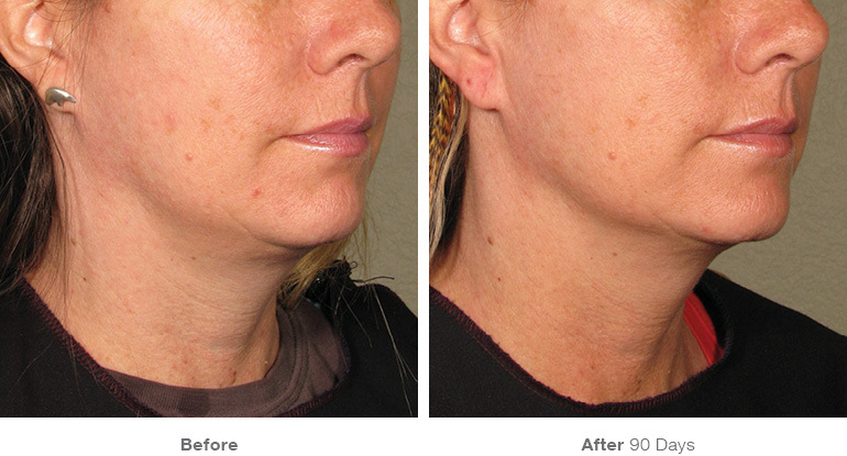 before_after_ultherapy_results_under-chin111