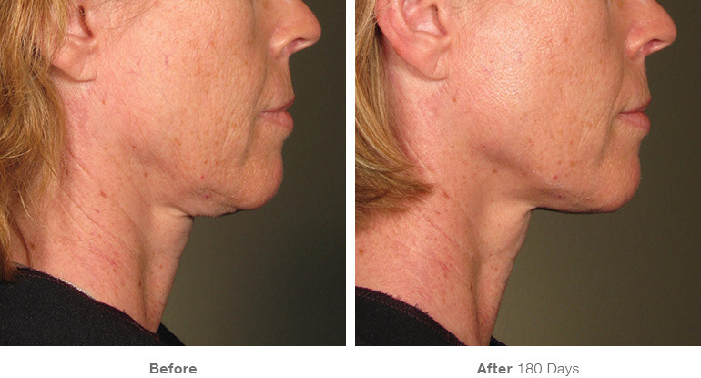 before_after_ultherapy_results_under-chin16