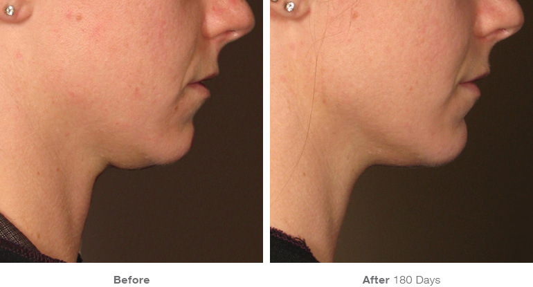 before_after_ultherapy_results_under-chin20