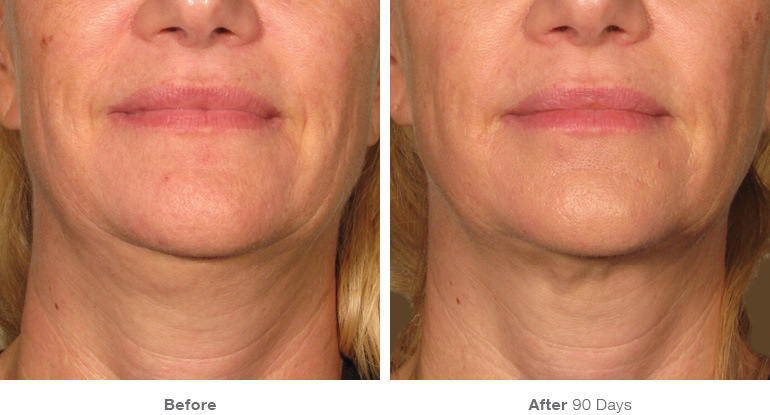 before_after_ultherapy_results_under-chin29