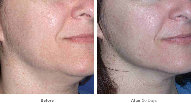 before_after_ultherapy_results_under-chin31