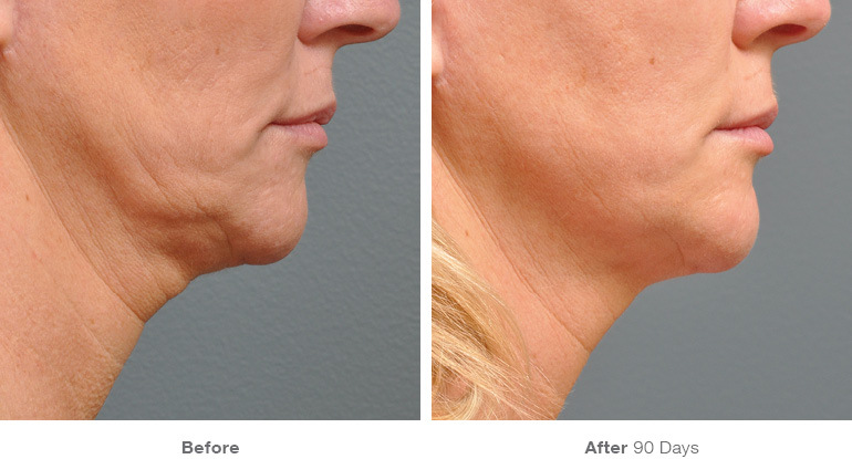 before_after_ultherapy_results_under-chin33