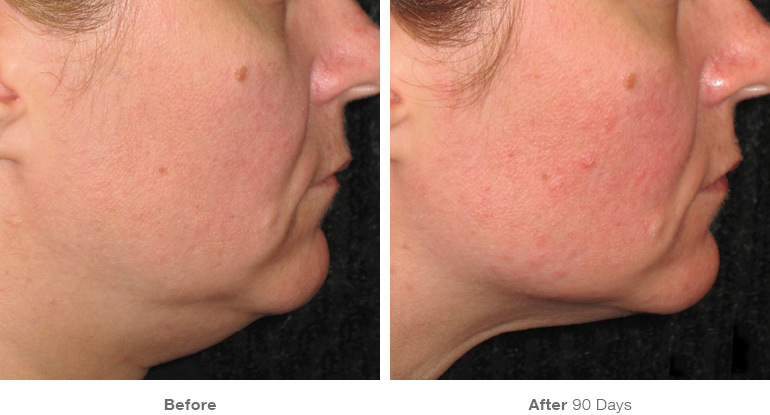 before_after_ultherapy_results_under-chin34