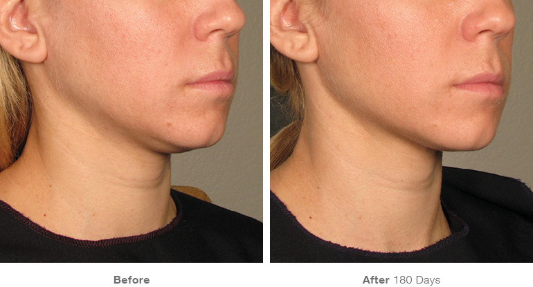 before_after_ultherapy_results_under-chin36