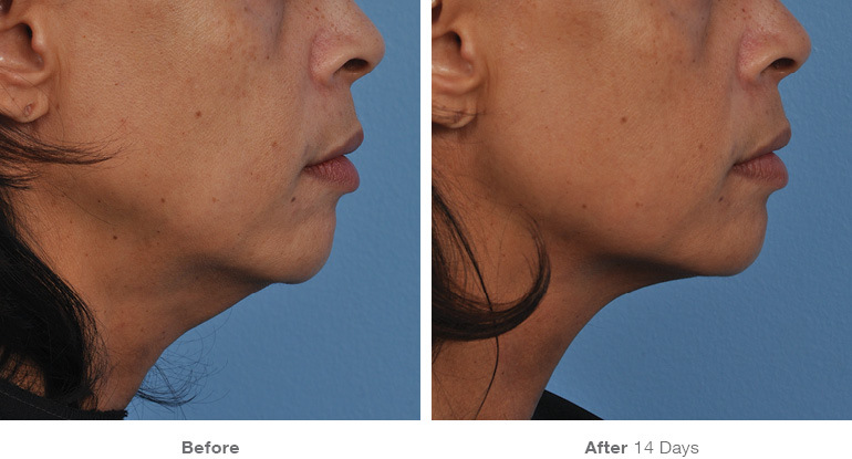 before_after_ultherapy_results_under-chin37