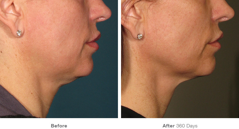 before_after_ultherapy_results_under-chin4