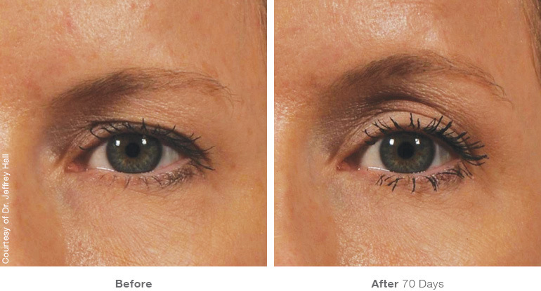 beforeafter_brow12