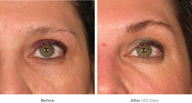 img_template_beforeafter_brow5