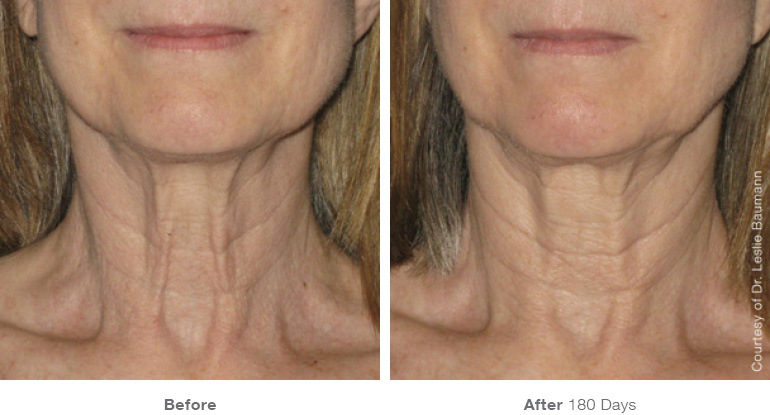 ultherapy-0028-0086w_180day_1tx_neck_gallery